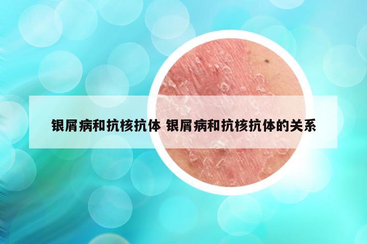 银屑病和抗核抗体 银屑病和抗核抗体的关系