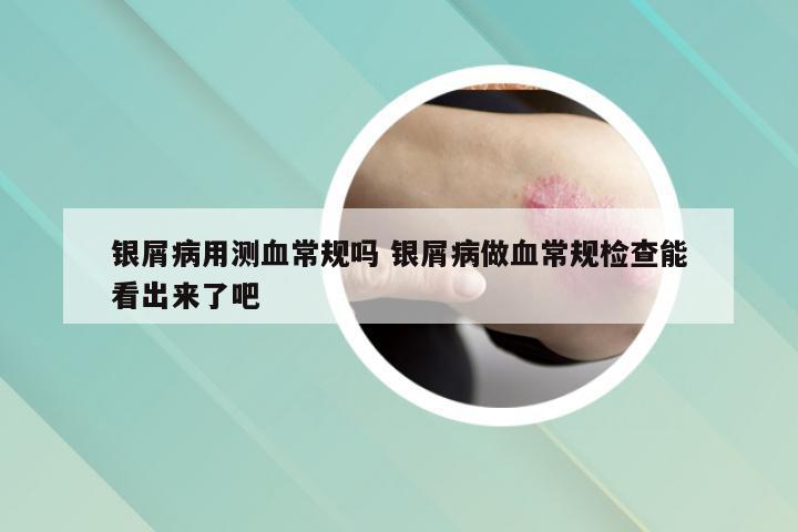 银屑病用测血常规吗 银屑病做血常规检查能看出来了吧