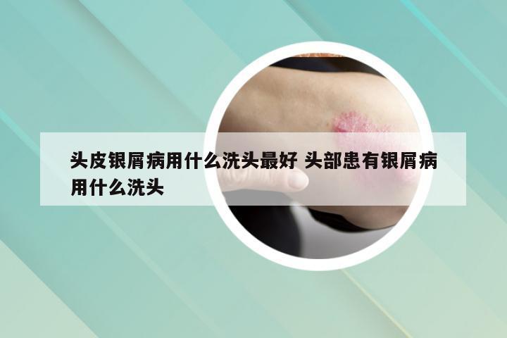 头皮银屑病用什么洗头最好 头部患有银屑病用什么洗头