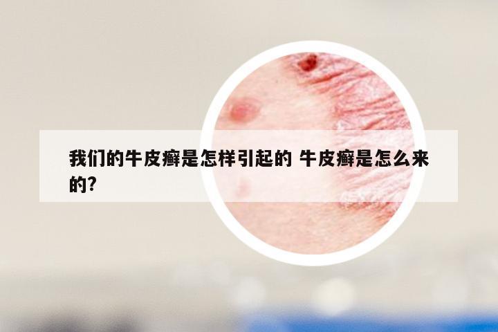 我们的牛皮癣是怎样引起的 牛皮癣是怎么来的?