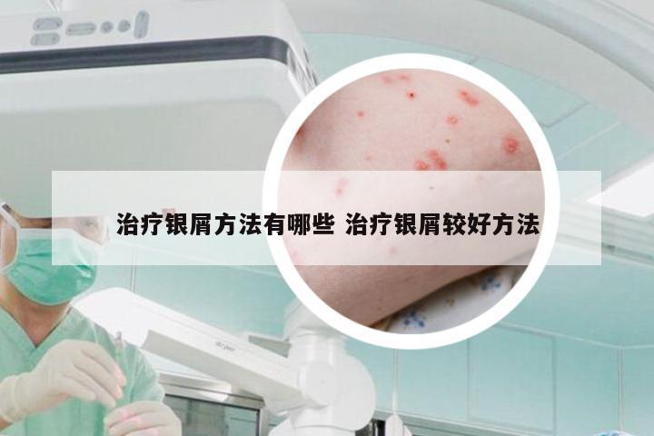治疗银屑方法有哪些 治疗银屑较好方法