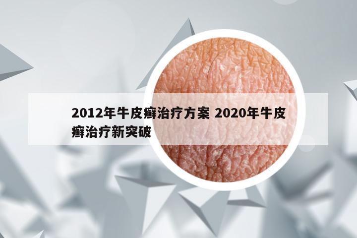2012年牛皮癣治疗方案 2020年牛皮癣治疗新突破