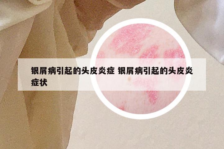 银屑病引起的头皮炎症 银屑病引起的头皮炎症状