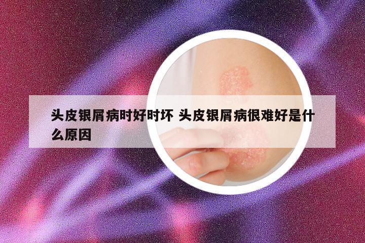 头皮银屑病时好时坏 头皮银屑病很难好是什么原因