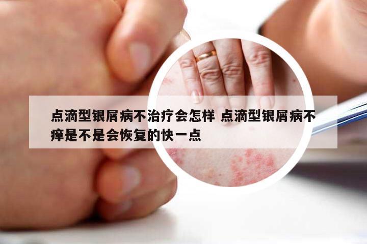 点滴型银屑病不治疗会怎样 点滴型银屑病不痒是不是会恢复的快一点