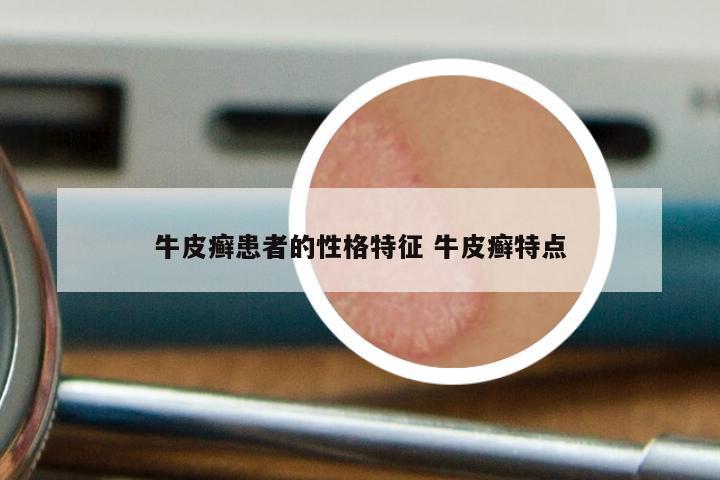 牛皮癣患者的性格特征 牛皮癣特点