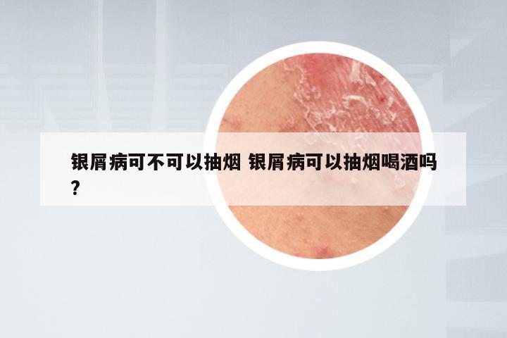 银屑病可不可以抽烟 银屑病可以抽烟喝酒吗?