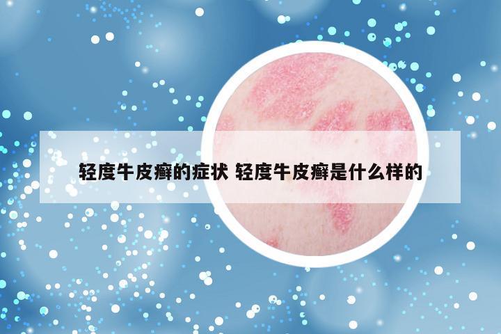轻度牛皮癣的症状 轻度牛皮癣是什么样的