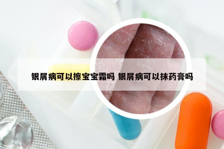银屑病可以擦宝宝霜吗 银屑病可以抹药膏吗