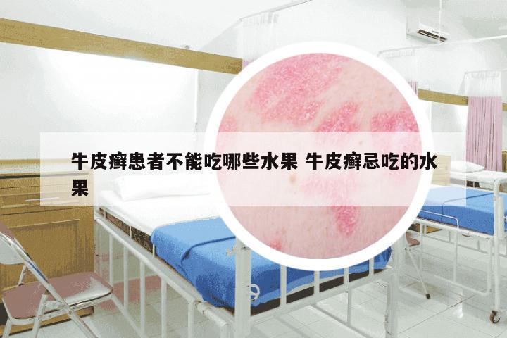 牛皮癣患者不能吃哪些水果 牛皮癣忌吃的水果