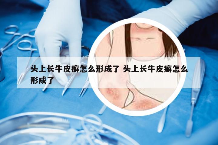 头上长牛皮癣怎么形成了 头上长牛皮癣怎么形成了