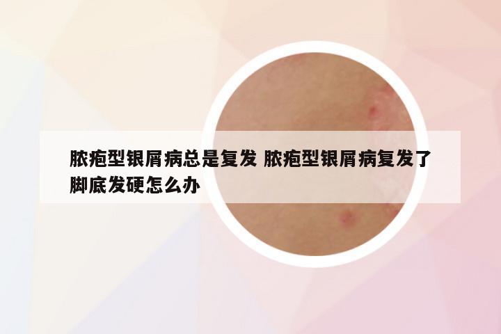 脓疱型银屑病总是复发 脓疱型银屑病复发了脚底发硬怎么办
