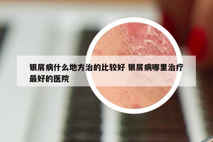 银屑病什么地方治的比较好 银屑病哪里治疗最好的医院