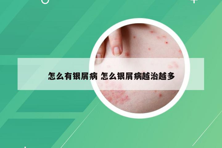 怎么有银屑病 怎么银屑病越治越多