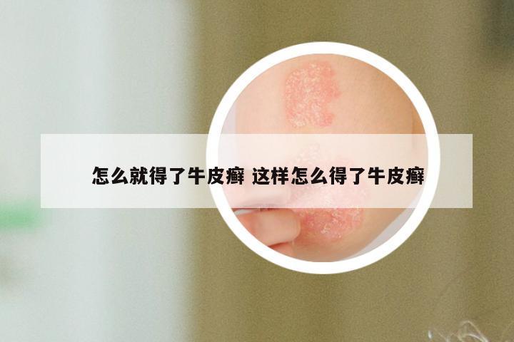 怎么就得了牛皮癣 这样怎么得了牛皮癣