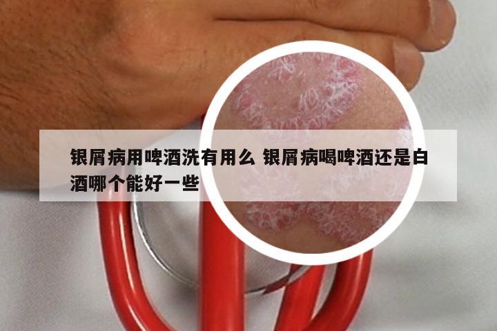 银屑病用啤酒洗有用么 银屑病喝啤酒还是白酒哪个能好一些