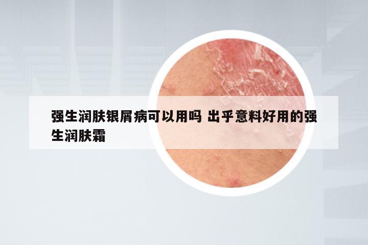 强生润肤银屑病可以用吗 出乎意料好用的强生润肤霜
