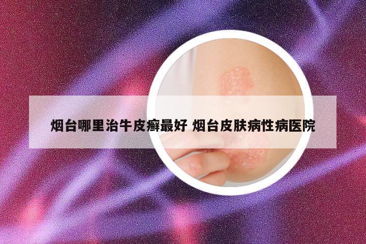 烟台哪里治牛皮癣最好 烟台皮肤病性病医院