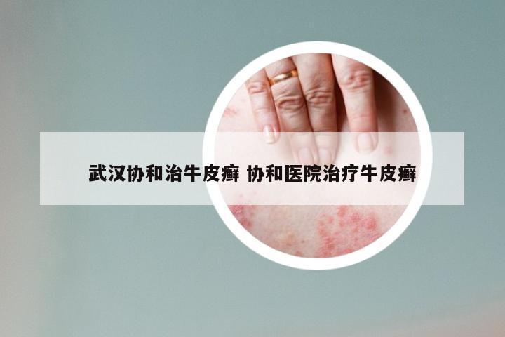 武汉协和治牛皮癣 协和医院治疗牛皮癣