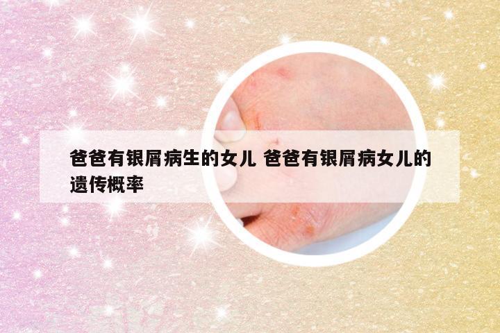 爸爸有银屑病生的女儿 爸爸有银屑病女儿的遗传概率
