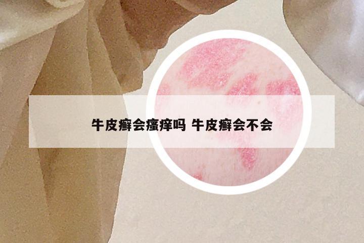 牛皮癣会瘙痒吗 牛皮癣会不会
