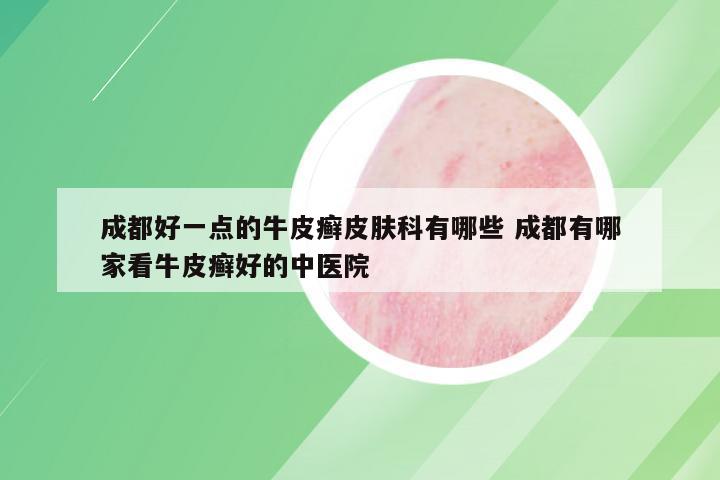 成都好一点的牛皮癣皮肤科有哪些 成都有哪家看牛皮癣好的中医院