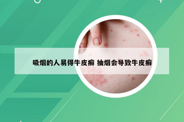 吸烟的人易得牛皮癣 抽烟会导致牛皮癣