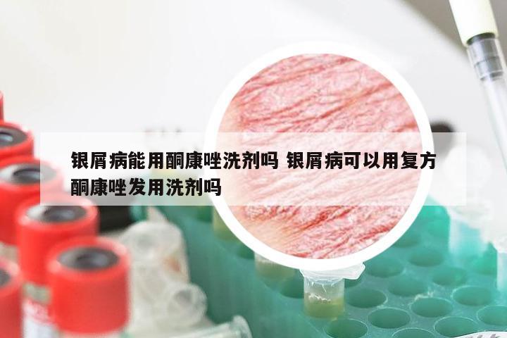 银屑病能用酮康唑洗剂吗 银屑病可以用复方酮康唑发用洗剂吗