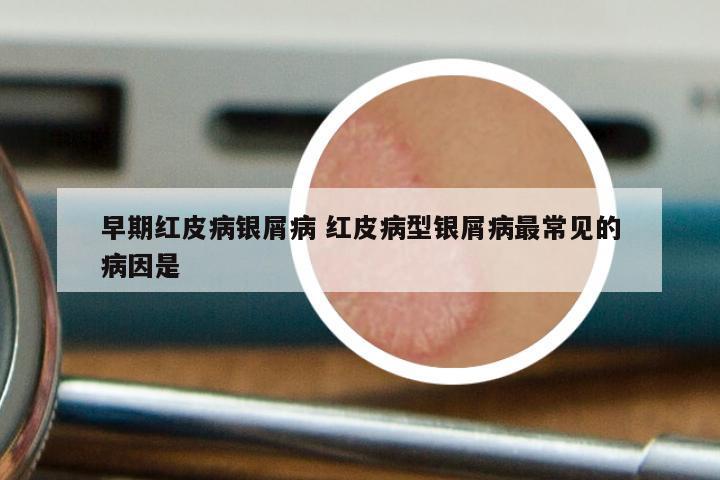 早期红皮病银屑病 红皮病型银屑病最常见的病因是