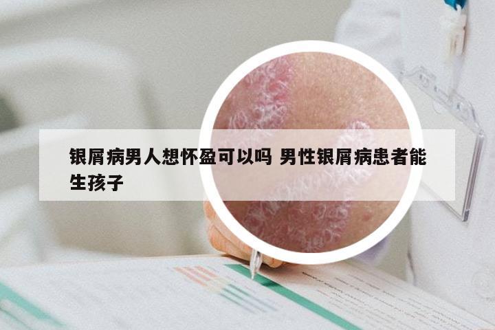 银屑病男人想怀盈可以吗 男性银屑病患者能生孩子