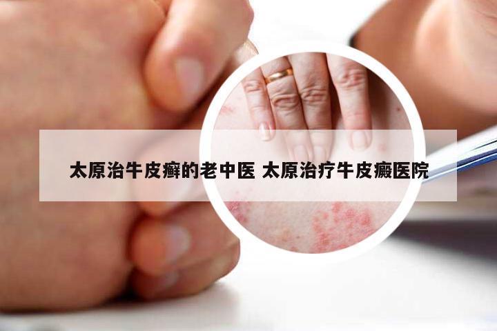 太原治牛皮癣的老中医 太原治疗牛皮癜医院