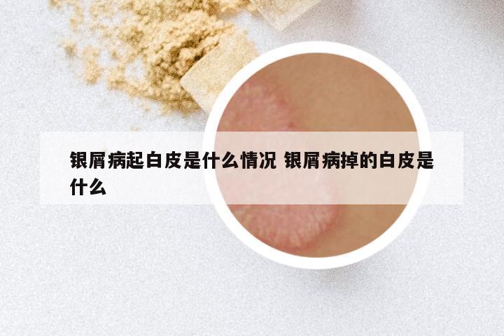 银屑病起白皮是什么情况 银屑病掉的白皮是什么