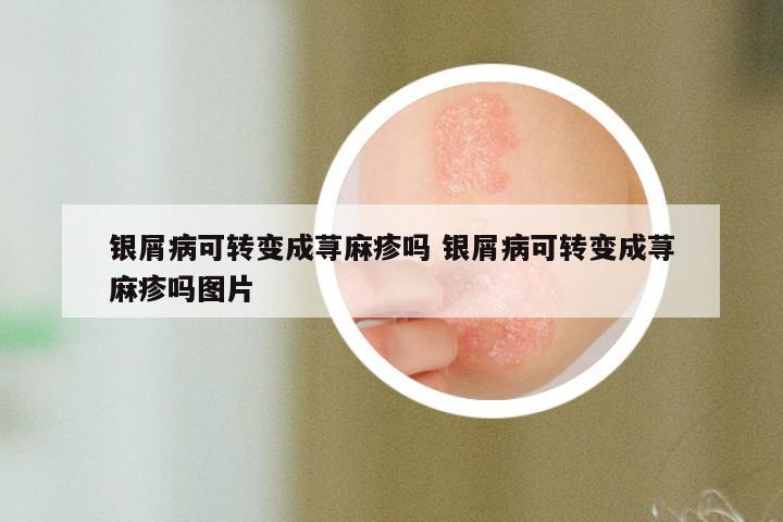 银屑病可转变成荨麻疹吗 银屑病可转变成荨麻疹吗图片