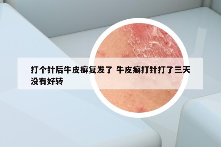 打个针后牛皮癣复发了 牛皮癣打针打了三天没有好转