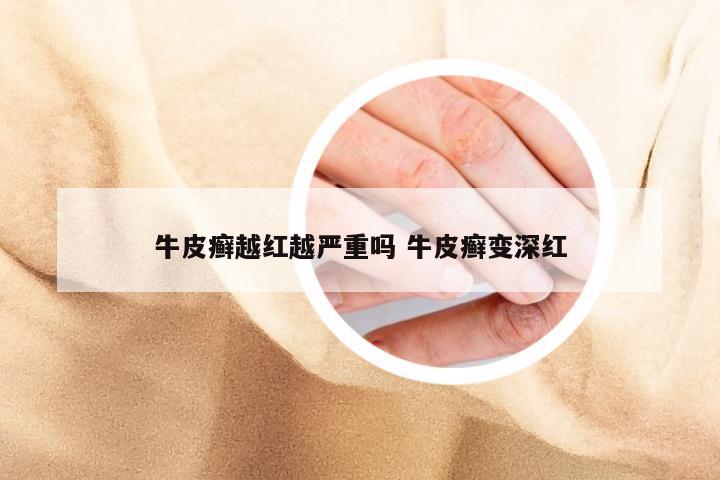牛皮癣越红越严重吗 牛皮癣变深红