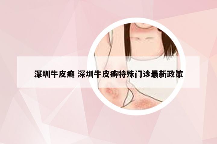 深圳牛皮癣 深圳牛皮癣特殊门诊最新政策
