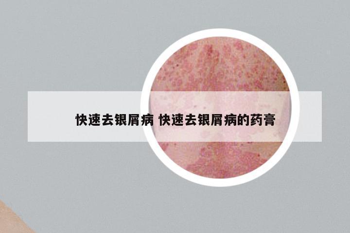 快速去银屑病 快速去银屑病的药膏