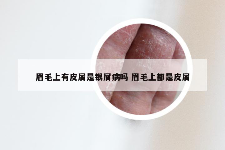 眉毛上有皮屑是银屑病吗 眉毛上都是皮屑