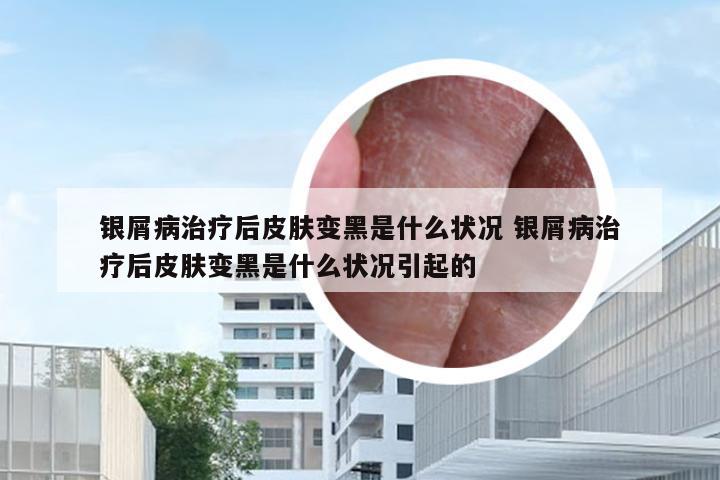银屑病治疗后皮肤变黑是什么状况 银屑病治疗后皮肤变黑是什么状况引起的