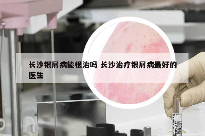 长沙银屑病能根治吗 长沙治疗银屑病最好的医生