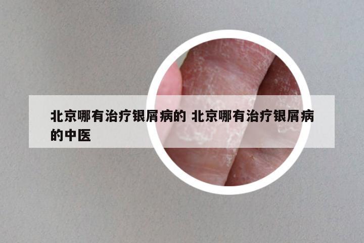 北京哪有治疗银屑病的 北京哪有治疗银屑病的中医