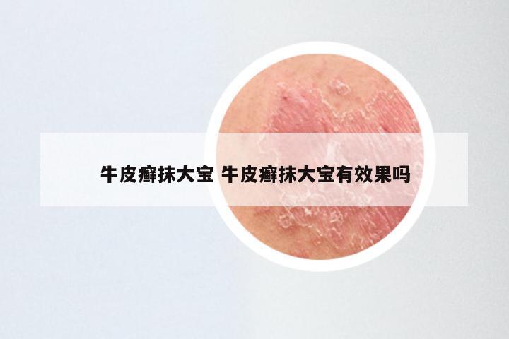 牛皮癣抹大宝 牛皮癣抹大宝有效果吗