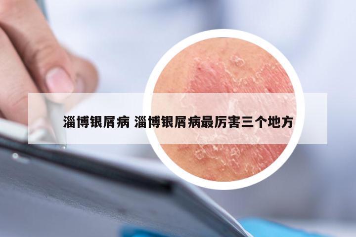淄博银屑病 淄博银屑病最厉害三个地方