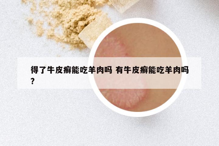 得了牛皮癣能吃羊肉吗 有牛皮癣能吃羊肉吗?