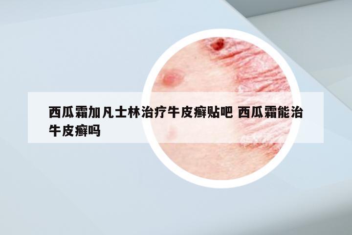 西瓜霜加凡士林治疗牛皮癣贴吧 西瓜霜能治牛皮癣吗