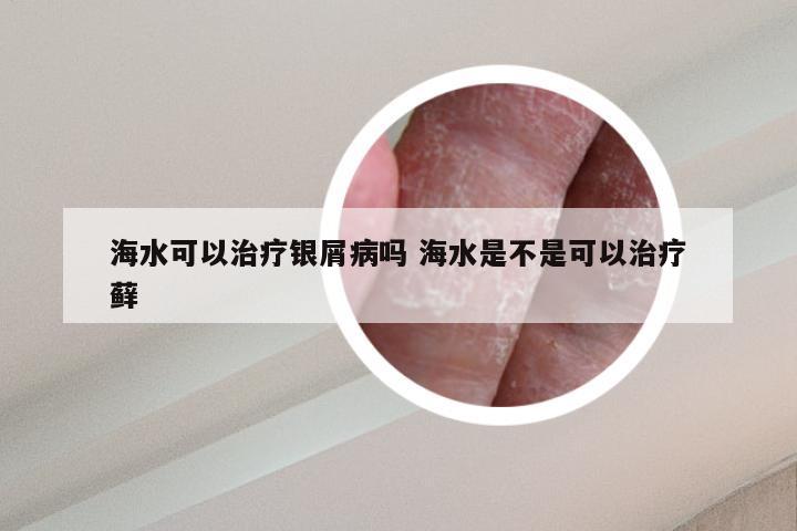海水可以治疗银屑病吗 海水是不是可以治疗藓
