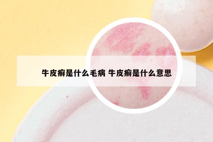牛皮癣是什么毛病 牛皮癣是什么意思