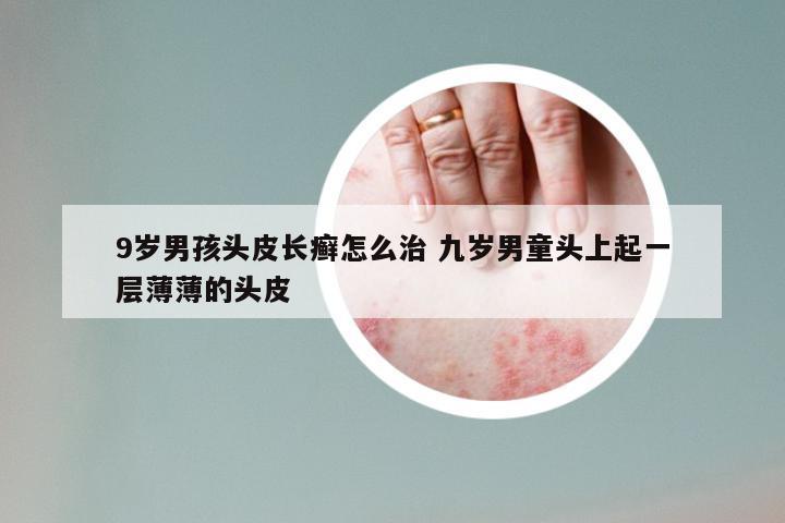 9岁男孩头皮长癣怎么治 九岁男童头上起一层薄薄的头皮