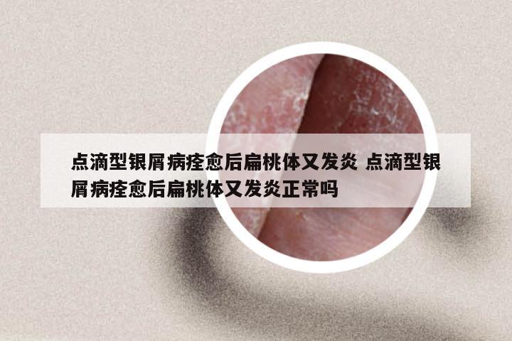 点滴型银屑病痊愈后扁桃体又发炎 点滴型银屑病痊愈后扁桃体又发炎正常吗
