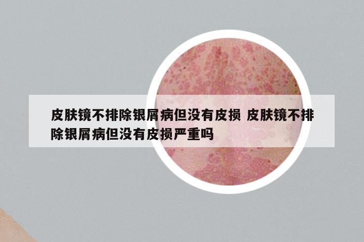 皮肤镜不排除银屑病但没有皮损 皮肤镜不排除银屑病但没有皮损严重吗